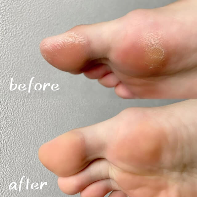 フット角質ケア